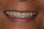 Fig 1. Preoperative, the patient’s existing anterior dentition appeared short proportionally. To esthetically redesign her smile, smile design study was used in determining the ideal proportion, shape, size, color, and style of the restored dentition.