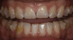 Fig 2. Although the patient had previously completed clear aligner therapy to achieve an improved occlusal scheme, at diagnostic work-up it was evident that the worn dentition required reconstructive treatment to replace severely worn enamel.