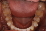 Fig 4. The severe wear required the replacement of missing enamel with a restorative treatment material that would provide optimal strength and occlusal toughness for long-term success.