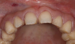 Fig 5. Teeth preparation for both arches (upper arch shown) was performed to remove broken, decayed, and decalcified enamel, leaving a base of healthy enamel.