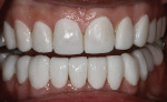 Fig 6. After final impressions and treatment records were taken, esthetic temporary prototypes were hand-sculpted to develop the patient’s new occlusion and smile design.