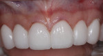 Fig 10. The anterior porcelain veneers were bonded with Choice 2 luting resin and light-cured. Margins were then refined with a No. 2 scalpel and fine carbide finishing bur.