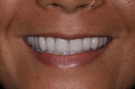 Fig 14. The health, function, and esthetics of the patient’s dentition was restored, and a more youthful smile was achieved.
