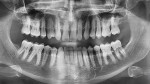 Fig 2. Pretreatment panoramic radiograph revealed a lack of space for implant placement at No. 7, open interproximal spaces throughout the maxillary arch with rotations, and crowding in the mandibular region.