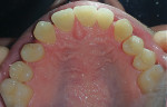 Fig 4. Maxillary occlusal view before treatment.