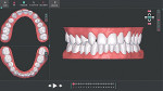 Fig 5. Initial ClearPilot treatment setup with 15 sets of aligners planned.
