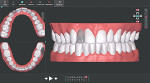Fig 9. After use of aligner No. 12, new digital scans were taken to add a “virtual pontic” for cosmetic purposes (composite added into the aligner at missing tooth No. 7) and ideal positioning for anticipated implant placement at month 9. Aligners Nos. 13 through 15 were not ordered. A new treatment plan increased the number of sets of aligners from the original 15 to 20.