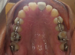 Fig 4. Occlusal view of maxillary arch before treatment.