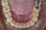 Fig 14. Occlusal view of mandibular arch after treatment.