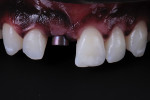 Fig 1. Initial intraoral photograph of implant with healing abutment.
