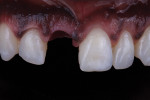 Fig 4. Intraoral photograph of implant site with ideal soft-tissue architecture after 4 weeks with the provisional restoration.