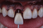Fig 8. Intraoral photograph of monolithic zirconia screw-retained implant crown at insertion.