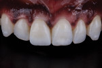 Fig 9. Final intraoral photograph of implant crown with natural surface texture, color, and translucency demonstrating successful restoration of a single maxillary central incisor.