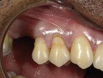 Fig 1. Pretreatment retracted close-up view of previously placed Class V restorations on teeth Nos. 4 and 5 that were failing and had become sensitive to cold.