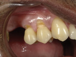 Fig 2. The old composite restorations were removed, and the enamel margins of the preparations were slightly beveled with coarse and fine diamond burs.