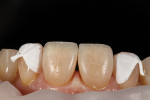 Fig 6. OMNICHROMA BLOCKER was used to replicate a dentin layer to help block out the hard incisal edge of the natural tooth.