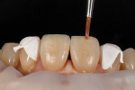 Fig 8. Colored liquid resins were used to help replicate the natural internal effects of the existing dentition with ochre, opaque chroma, and white. Using the fine tip of a sable brush, the colored resins were applied to replicate the vertical craze lines and chromatic effects.