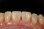 Fig 10. Immediate post-treatment after texturizing and polishing.