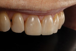 Fig 11. Immediate post-treatment right lateral view showing how the composite blended seamlessly into the existing enamel.