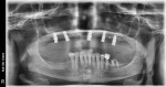 Fig 3. Due to patient factors, there was a moderate amount of radiographic bone loss around the implants, which appeared to be insufficient to support a fixed restoration. Ultimately, the patient opted for a bar overdenture.