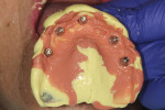 Fig 4. An impression of the dental implants was made with VPS (First Half™, Zest Dental Solutions).