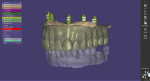 Fig 5. Scan bodies for the implants were scanned using an intraoral scanner (Medit i700, Medit, medit.com), and a prototype prosthesis was fabricated in dental laboratory software (DentalCAD, exocad, exocad.com).