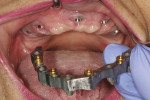 Fig 8. The patient returned for prosthesis placement. Healing abutments were removed, and the LOCATOR bar was placed onto the implants.