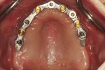 Fig 9. The LOCATOR bar overdenture contours were verified, ensuring the patient would have sufficient ability to clean underneath the prosthesis for the long-term health of the dental implants.