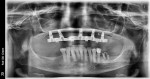 Fig 10. A radiograph was obtained to confirm complete adaptation of the LOCATOR bar framework prior to prosthesis placement.