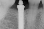Fig 1. The 3.6 mm x 15 mm press-fit implant and abutment with which the patient presented.