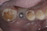Fig 2. Intraoral preoperative occlusal view.