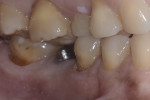 Fig 3. Intraoral preoperative buccal view; note the lack of critical abutment height required for retention.