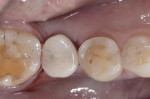 Fig 8. Provisional cement-retained crown.
