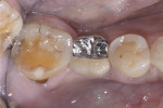 Fig 9. Final cement-retained crown, occlusal view.