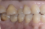 Fig 10. Final cement-retained crown, buccal view; note the necessity of using buccal facing porcelain due to insufficient interocclusal clearance.