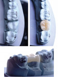Occlusal and buccal views of a lithium disilicate glass-ceramic occlusal onlay on the model (Case courtesy of dental student Brett Seigel and supervised by Aous Abdulmajeed, DDS, PhD.).