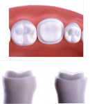 Examples of different preparation designs for partial-coverage restorations.