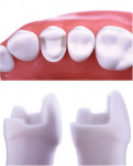 Examples of different preparation designs for partial-coverage restorations.