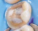 A partial coverage preparation demonstrating a simple geometry with smooth transitions. Note the presence of enamel 360 degrees around the preparation’s supragingival margin (Case courtesy of Awab Abdulmajeed, DDS, MS.).