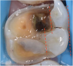 Cusps with less than 2 mm of remaining width should be included in the preparation design and capped, and those with greater width should be maintained (Case courtesy of Awab Abdulmajeed, DDS, MS.).