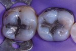 Preoperative image of teeth Nos. 18 and 19 demonstrating failing amalgam restorations, smooth surface caries, and a structural crack undermining the mesiolingual cusp of tooth No. 19.