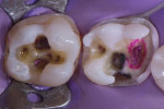 Occlusal view following removal of the restorations and preparation. Note the crack- and caries-free peripheral seal zone that was established prior to completion of selective caries removal. The preparation design followed the principle of defect-driven tooth structure removal, and the mesiolingual cusp was removed during crack dissection. In this case, a direct modality facilitated the preservation of functional cusps that might otherwise have been sacrificed with an indirect approach.