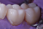 Postoperative photograph of the completed restorations demonstrating a final polish created using a series of diamond polishing wheels (A.S.A.P. ® Dailies, Clinician’s Choice).