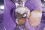 Preoperative image of a previously restored maxillary premolar with a fractured palatal cusp.