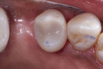 Postoperative image of the restoration following final polishing with the diamond polishing wheels and occlusion check.