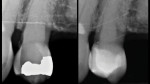 Side-by-side comparison of the preoperative (left) and postoperative (right) periapical radiographs.