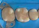 Image of maxillary molars following final preparation, deep margin elevation, and “biobase” creation for a semidirect technique (Case courtesy of Jamie Brooks, DDS, at Brooks Dental Studio, Tacoma, Washington).