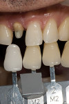 Figure 3: Using the Vita Classical Shade Guide arranged by value and working by a process of elimination to get to four tabs that cover the value range of the tooth being evaluated.