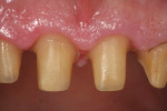 Figure 6: Note the excellent tissue condition upon the removal of the provisional restoration 4 weeks later.