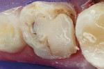 Figure 1  Failed resin-based composite restoration of a primary second molar.